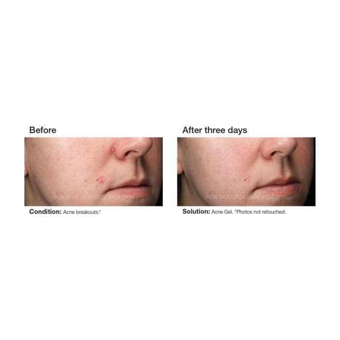 Acne Gel — view 3