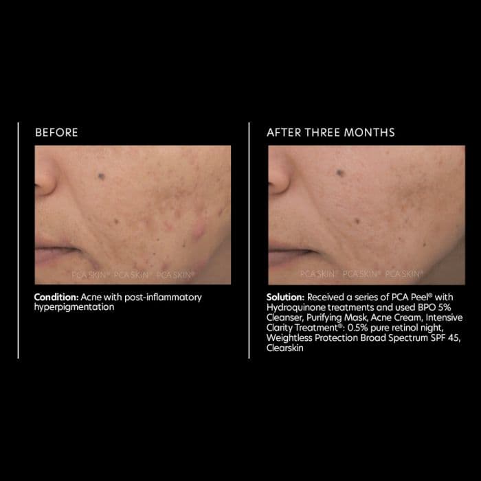 Acne Cream — view 2