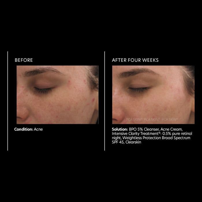 Intensive Clarity Treatment®: 0.5% pure retinol — view 3