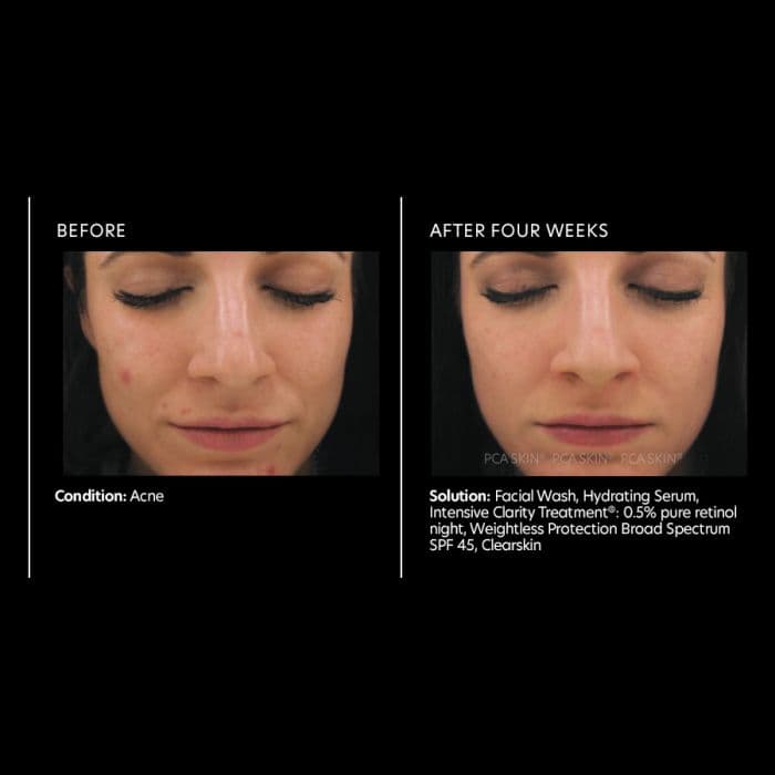 Intensive Clarity Treatment®: 0.5% pure retinol — view 2