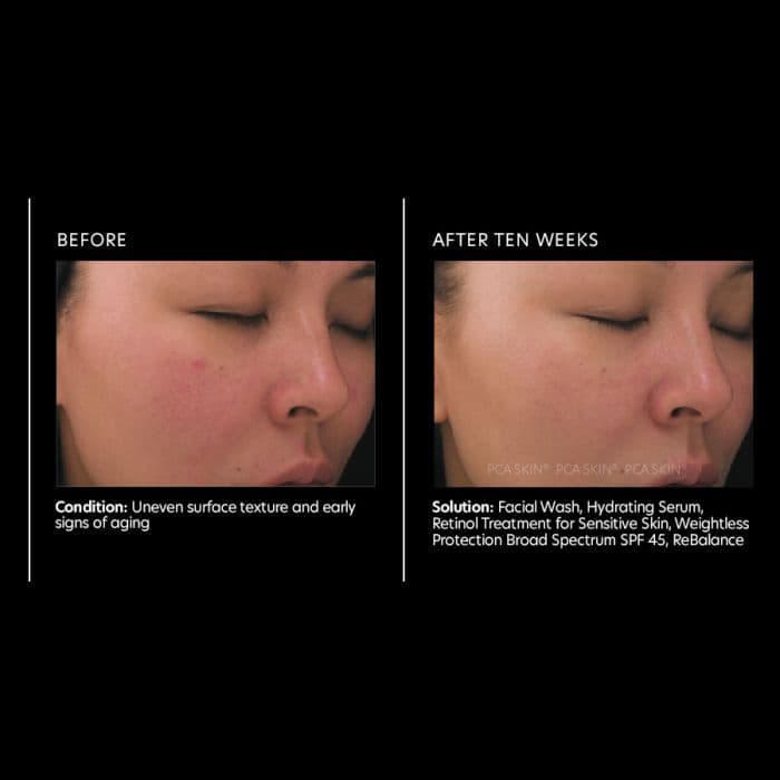 Retinol Treatment for Sensitive Skin — view 2
