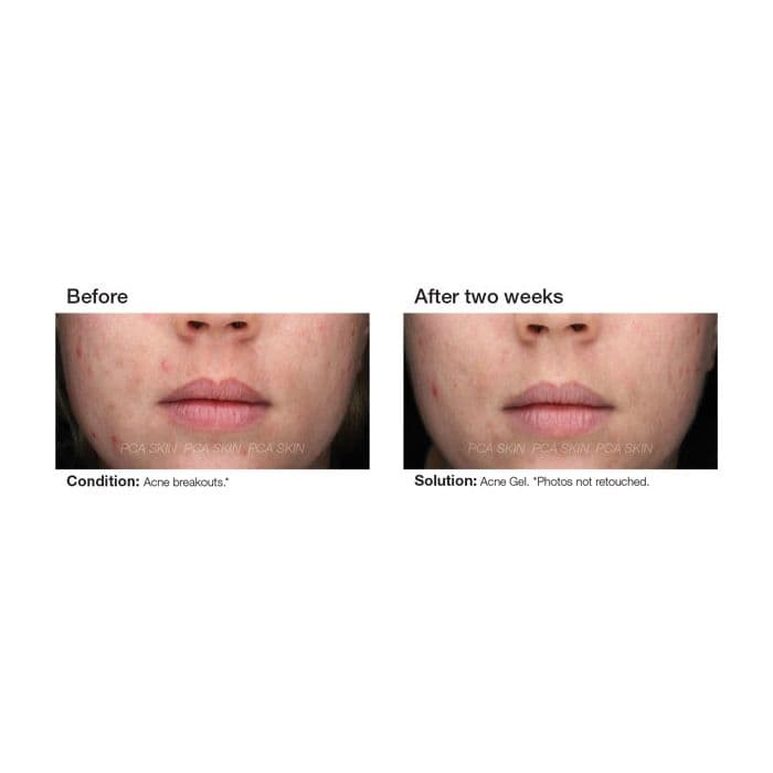 Acne Gel — view 2